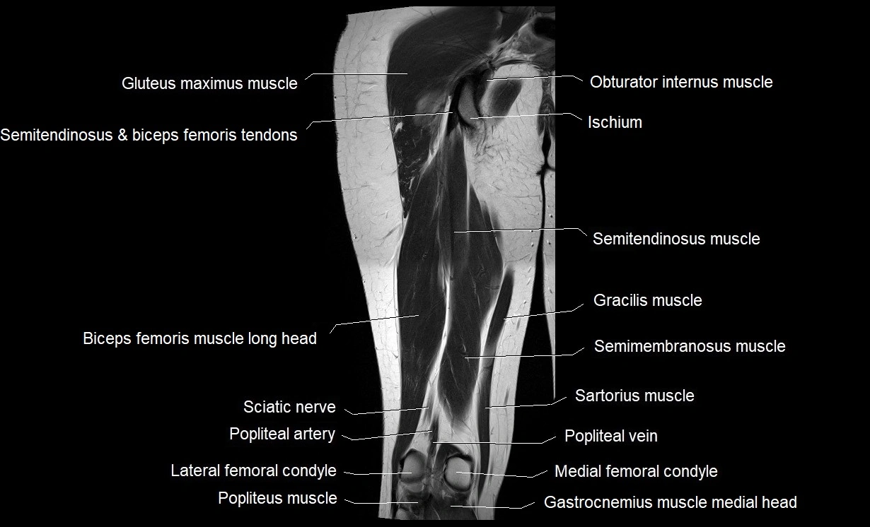 MRI thigh coronal cross sectional anatomy image 17.webp